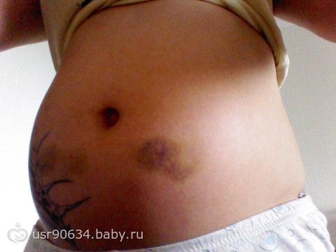 Как сделать чтобы гематома рассосалась Как сделать чтобы гематома рассосалась