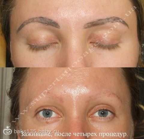 Татуаж во время приема антибиотиков Татуаж во время приема антибиотиков