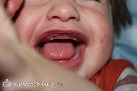 Как растут верхние зубы у грудничков Как растут верхние зубы у грудничков