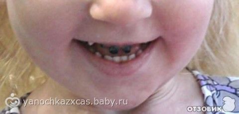 За месяц разрушились зубы За месяц разрушились зубы