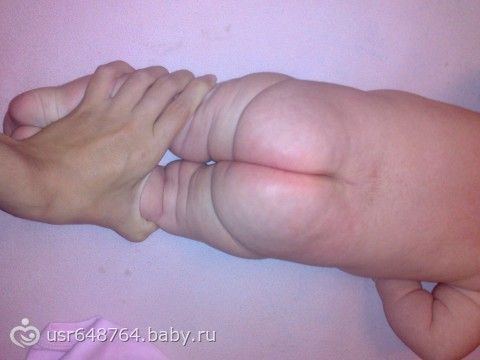 Если у новорожденного неровные складки Если у новорожденного неровные складки