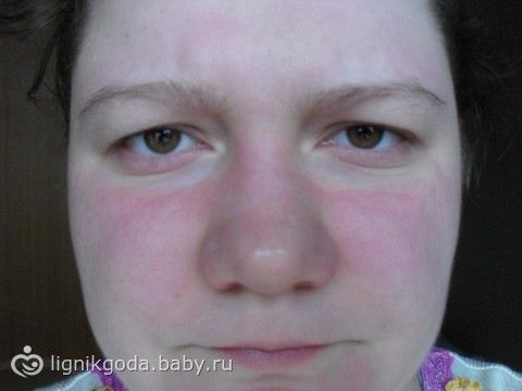 Что делать если передержала маску на лице Что делать если передержала маску на лице