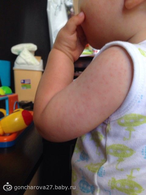 2-летний ребенок сыпь по всему телу 2-летний ребенок сыпь по всему телу