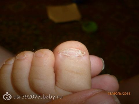 Как выглядит грибок ногтей на руках у ребенка Как выглядит грибок ногтей на руках у ребенка