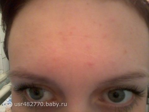 Мелкие прыщи на лбу (как сыпь причины и лечение) Маячок на ножницы (три мои сложности)