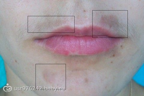 guboy kak udalit pyatno nad zdes sluchayno spetsialno Пятно над губой как удалить фото