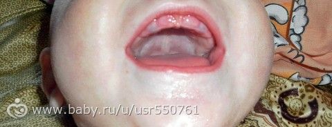 Ребенок ударился зубами десна посинела Ребенок ударился зубами десна посинела