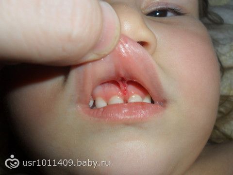 Повредила уздечку верхней губы Повредила уздечку верхней губы