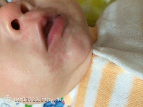 Почему у ребенка прыщики вокруг рта Почему у ребенка прыщики вокруг рта