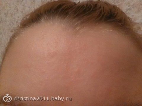 Рассада. Как вырастить здоровую качественную Прыщи на попе. Как избавиться от прыщей на попе (фото)