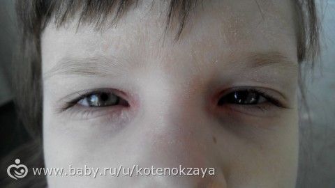 Девочки,наша сумасшедшая аллергия...и я не знаю,что делать...((