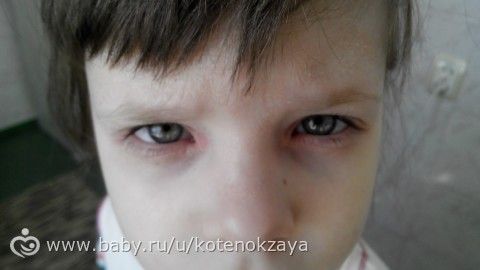 Девочки,наша сумасшедшая аллергия...и я не знаю,что делать...((