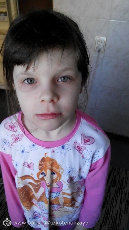 Девочки,наша сумасшедшая аллергия...и я не знаю,что делать...((