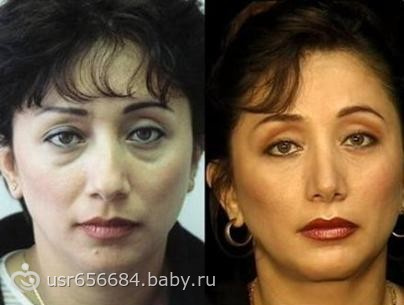 Как избавиться от мешков под глазами?