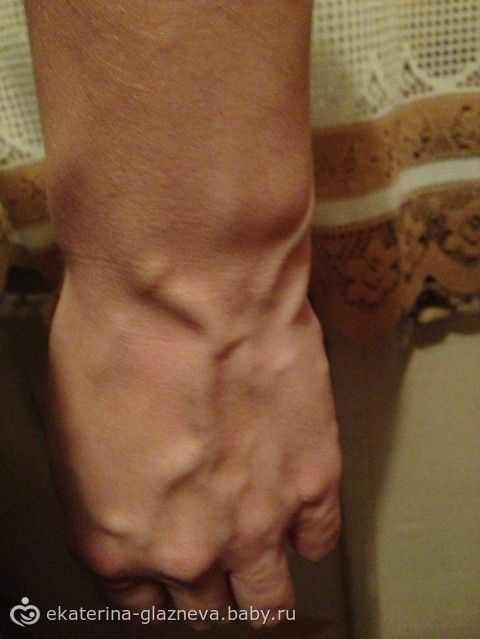 Вены на грудной клетке
