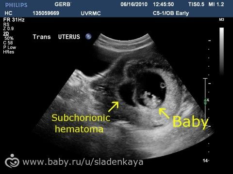 Гематома в матке во время беременности.