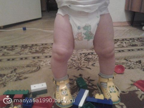 Как исправить Х-образную деформацию ног у ребенка