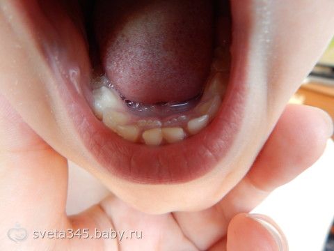 Что делать когда зубы растут вторым рядом Что делать когда зубы растут вторым рядом