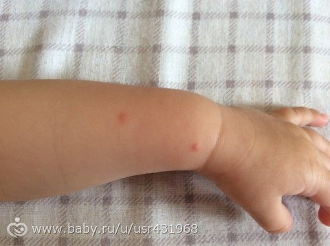 Прыщики похожие на укусы комаров у ребенка фото Прыщики похожие на укусы комаров у ребенка фото