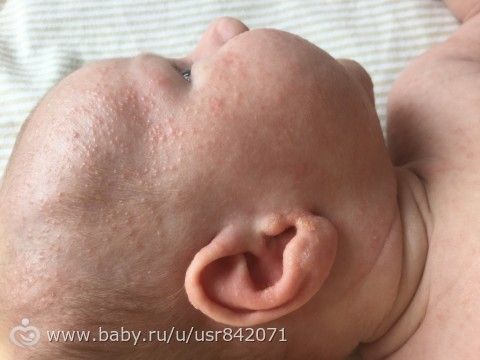 Это стафилококковая инфекция или что это?