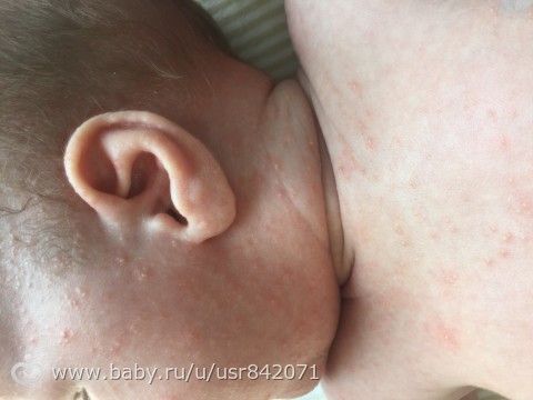 Это стафилококковая инфекция или что это?