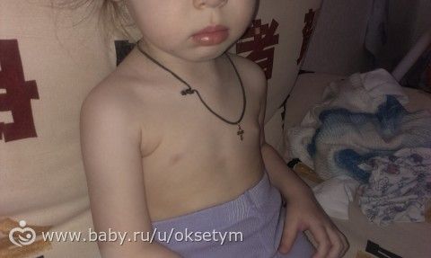 диагноз ППР, телархе