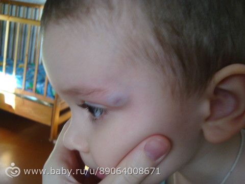 Ребенку год ударился затылком. Шишка на голове у ребенка после удара. Ребенок ударился затылком и образовалась шишка.