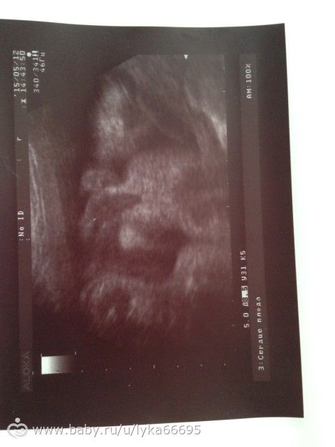 Моя третья беременность, второе кесарево сечение. Роды в 33-34 недели.