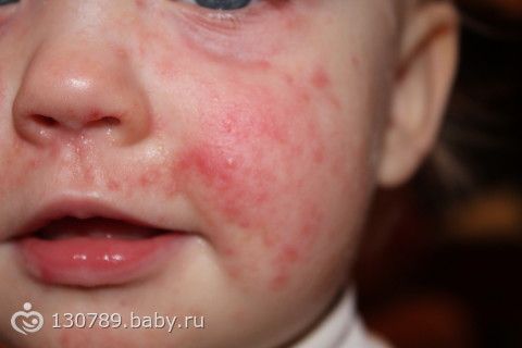 раздражение у ребенка на лице фото онлайн раздражение у ребенка на лице фото
